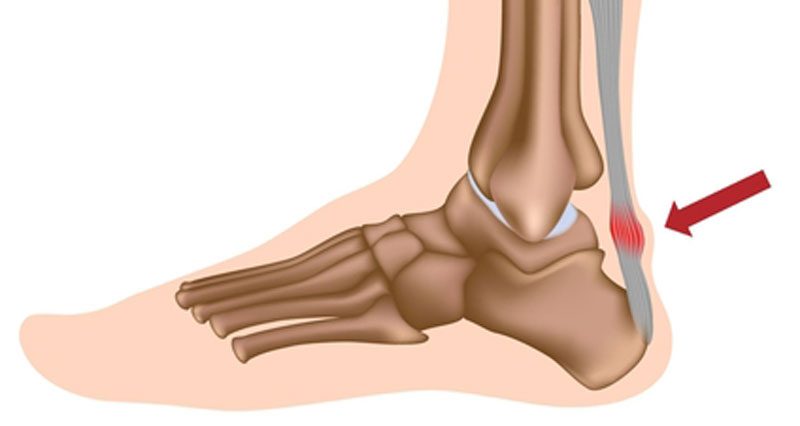 foot pain achilles tendon area