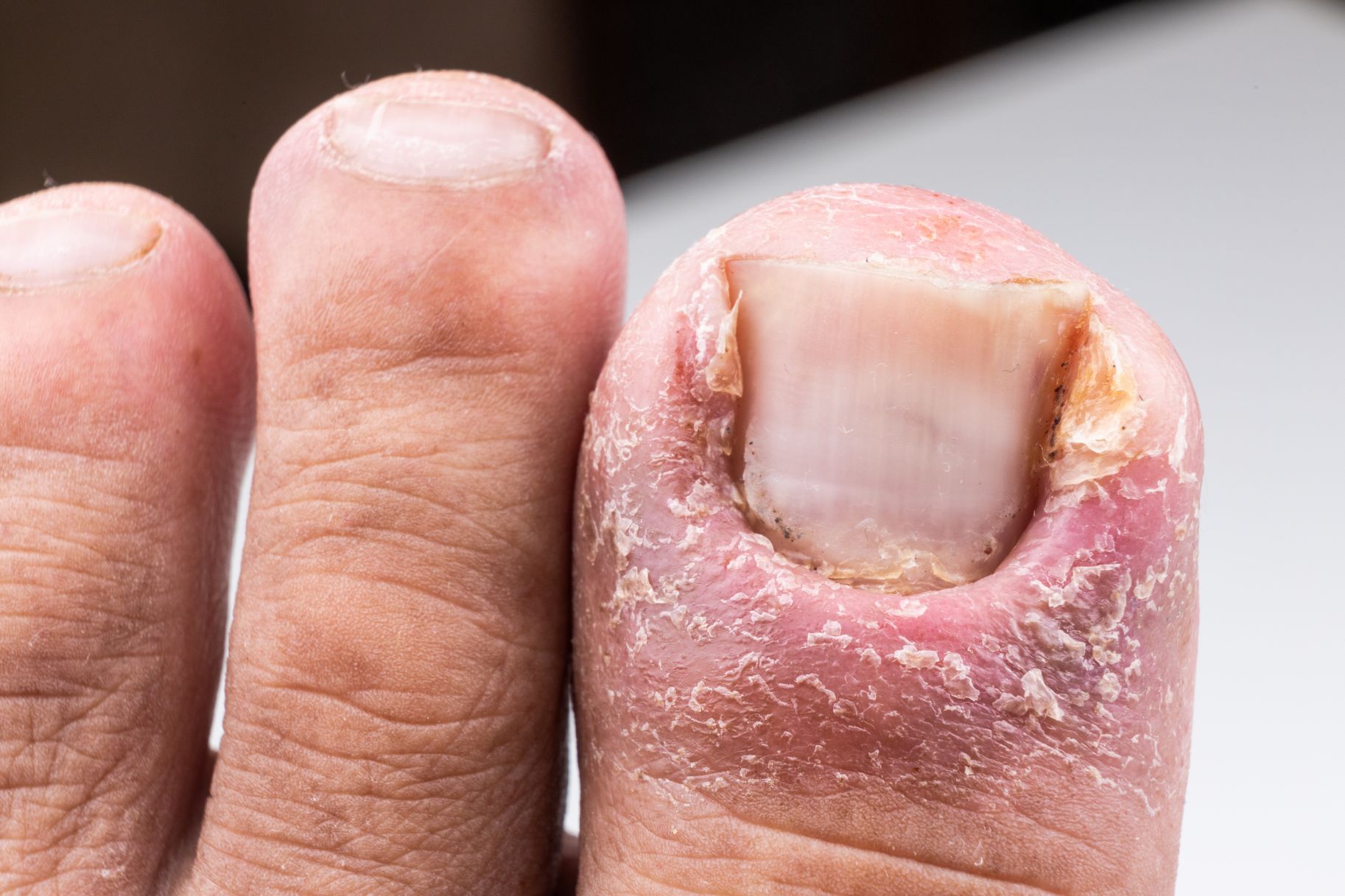 Everything You Need To Know About Toenail Fungus