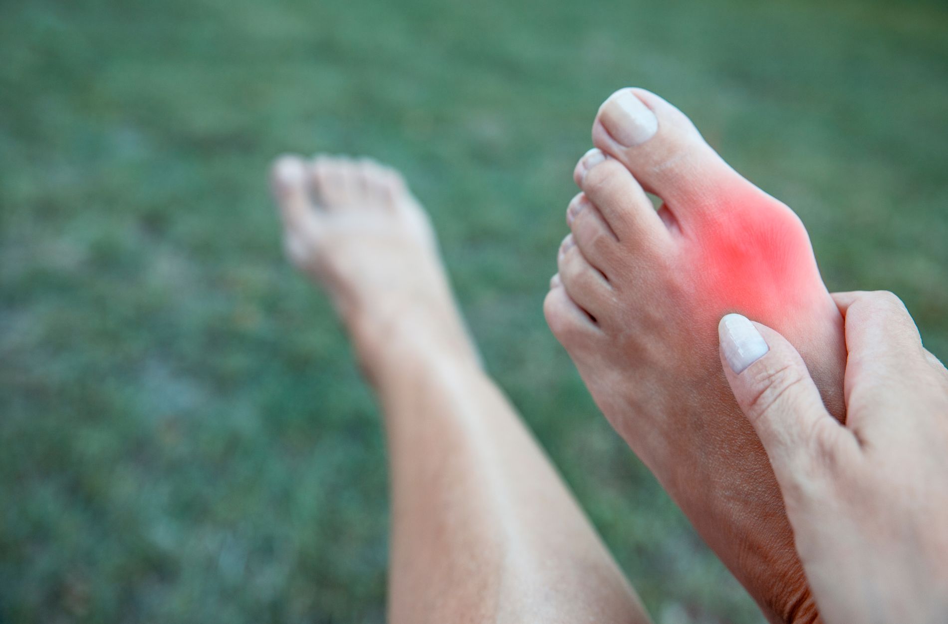 Lapiplasty Bunion Treatment: Transforming Bunion Correction